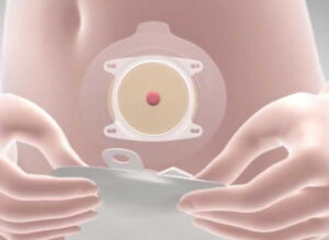 Stomia: Assistenza specializzata di fisioterapia e riabilitazione presso FisioSalus per il recupero completo e personalizzato del paziente