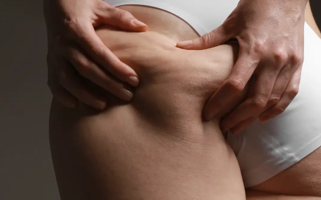Come Trattare la Cellulite con Fisioterapia e Dermoestetica