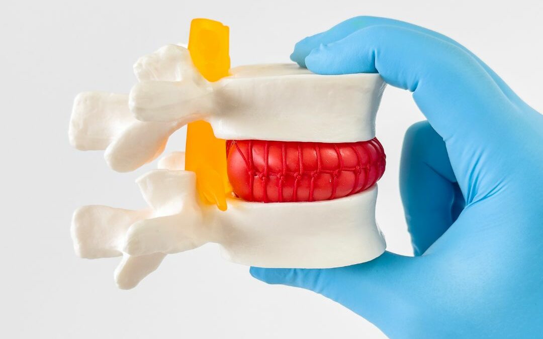 Ernia del Disco Lombare e Cervicale: Sintomi, Cause e Cure Efficaci