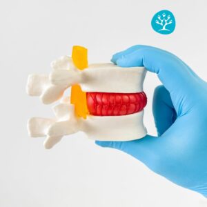 Fisioterapista mostra un modello di ernia del disco per spiegare le cause della sciatica e del dolore lombare.