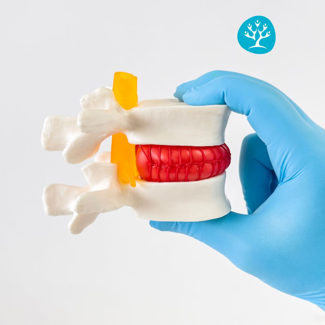 Fisioterapista mostra un modello di ernia del disco per spiegare le cause della sciatica e del dolore lombare.
