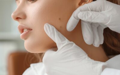 Mappatura dei Nei a Perugia: Guida completa alla prevenzione del Melanoma