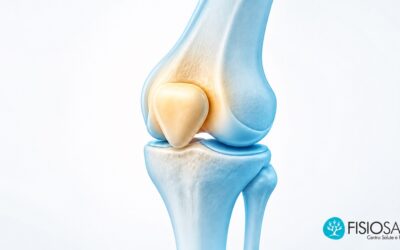 Dolore al ginocchio sulle scale: sindrome femoro-rotulea e riabilitazione